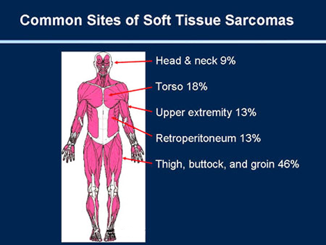 Sarcomas